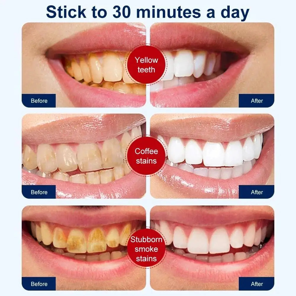 Blanchisseur de dents RtopR مبيض الأسنان