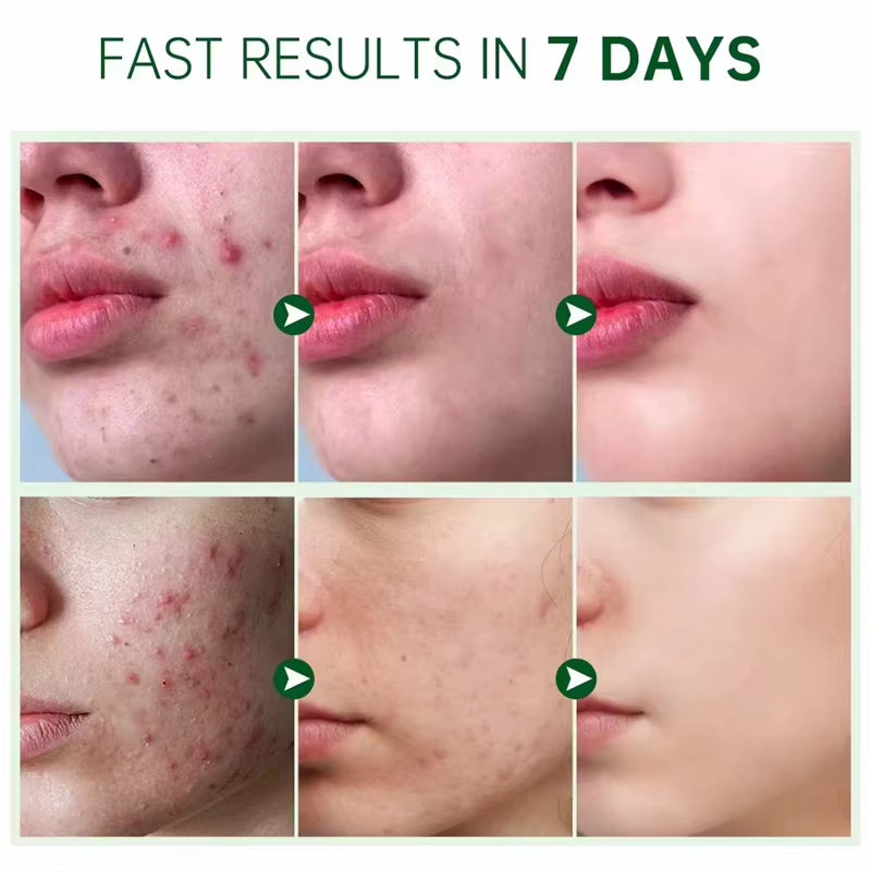 Crème visage pour traiter l'acné et les boutonsكريم الوجه لعلاج حب الشباب والبثور
