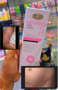 Aishun Beauty Anti-Stretch Mark Cream (100g) كريم أيشون بيوتي المضاد لعلامات التمدد (100 غرام)